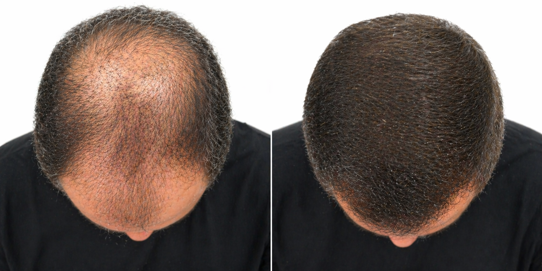 Before and after — male LumiGrow Cap result